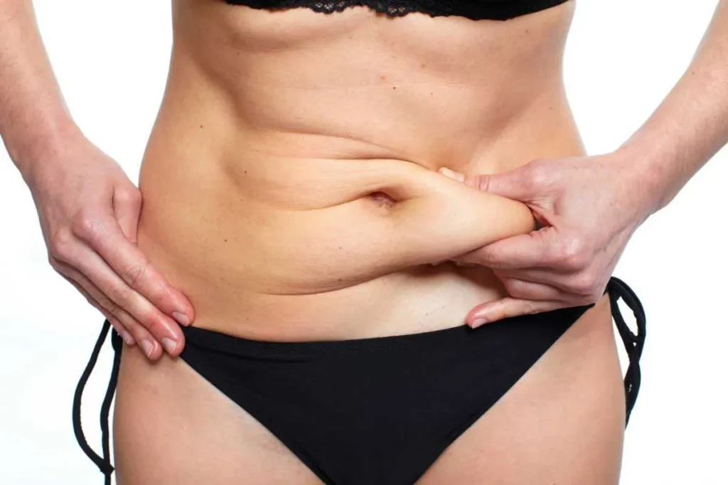 Abdominoplastia en Chihuahua elimina el exceso de grasa en el abdomen.