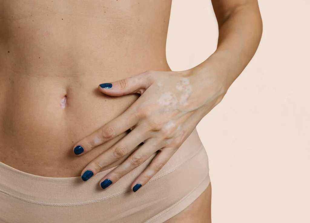 Cuidados después de la abdominoplastia