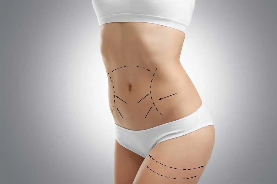 Áreas donde se puede aplicar una abdominoplastia en Chihuahua.